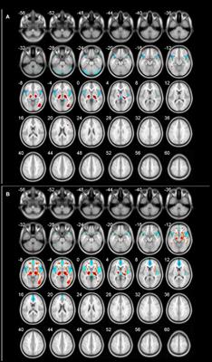 Gender-Related Differences in Regional Cerebral Glucose Metabolism in Normal Aging Brain